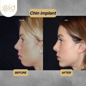 Resultados antes y después de implante de mentón en ID Clinic Bangkok, perfil mejorado