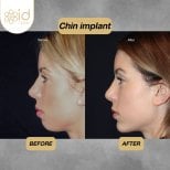 Resultados antes y después de implante de mentón en ID Clinic Bangkok, perfil mejorado
