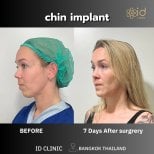 Resultados antes y después de implante de mentón en ID Clinic Bangkok, contorno mejorado