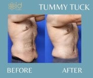 Before and after tummy tuck results at ID Clinic Bangkok, improved abdominal contour in male