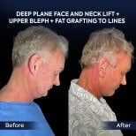 Before and after deep plane facelift and neck lift results at Dr. Safa Manav Clinic