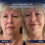 Before and after face and neck lift with blepharoplasty results at Dr. Safa Manav Clinic