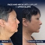 Before and after facelift, neck lift, lip lift, upper blepharoplasty at Dr. Safa Manav Clinic result