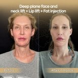 Before and after facelift, neck lift, lip lift, and fat injection at Dr. Safa Manav Clinic results