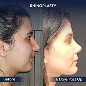 Before and after rhinoplasty results at Dr. Safa Manav Clinic, nose reshaping in 6 days