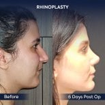 Before and after rhinoplasty results at Dr. Safa Manav Clinic, nose reshaping in 6 days