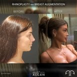 Before and after rhinoplasty and breast augmentation results at Dr. Mehmet Fatih Algan Clinic