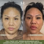 Facelift and blepharoplasty before and after results at Dr. Safa Manav Clinic, facial rejuvenation