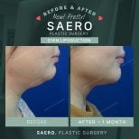 Результаты липосакции второго подбородка до и после в SAERO Plastic Surgery, улучшен контур
