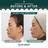 Результаты липосакции второго подбородка до и после в SAERO Plastic Surgery, видимый контур