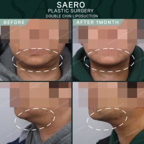 Результаты липосакции второго подбородка до и после в SAERO Plastic Surgery, улучшена линия подбородка