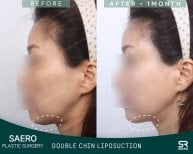 Результаты липосакции второго подбородка до и после в SAERO Plastic Surgery, улучшен овал лица
