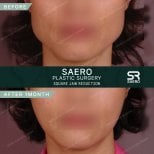 Before and after square jaw reduction at SAERO Plastic Surgery – visible face contour result