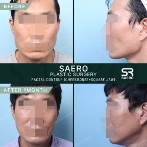 نتائج نحت الوجه قبل وبعد في SAERO Plastic Surgery، عظام الخد والفك