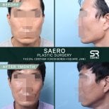 نتائج نحت الوجه قبل وبعد في SAERO Plastic Surgery، عظام الخد والفك