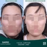 نتائج قبل وبعد تحديد الوجه (الفك المربع) في عيادة SAERO لجراحة التجميل