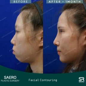 نتائج نحت الوجه قبل وبعد في SAERO Plastic Surgery، تحسين مظهر خط الفك