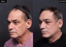Facelift before and after results at VG Plastic Surgery – visible facial rejuvenation in male patient
