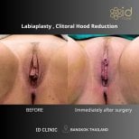 Before and after labiaplasty and clitoral hood reduction results at ID Clinic Bangkok