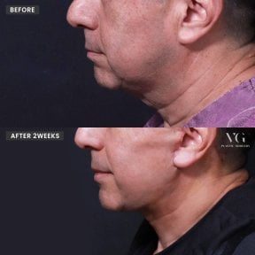 Результати ліпосакції другого підборіддя до і після у VG Plastic Surgery, покращений контур