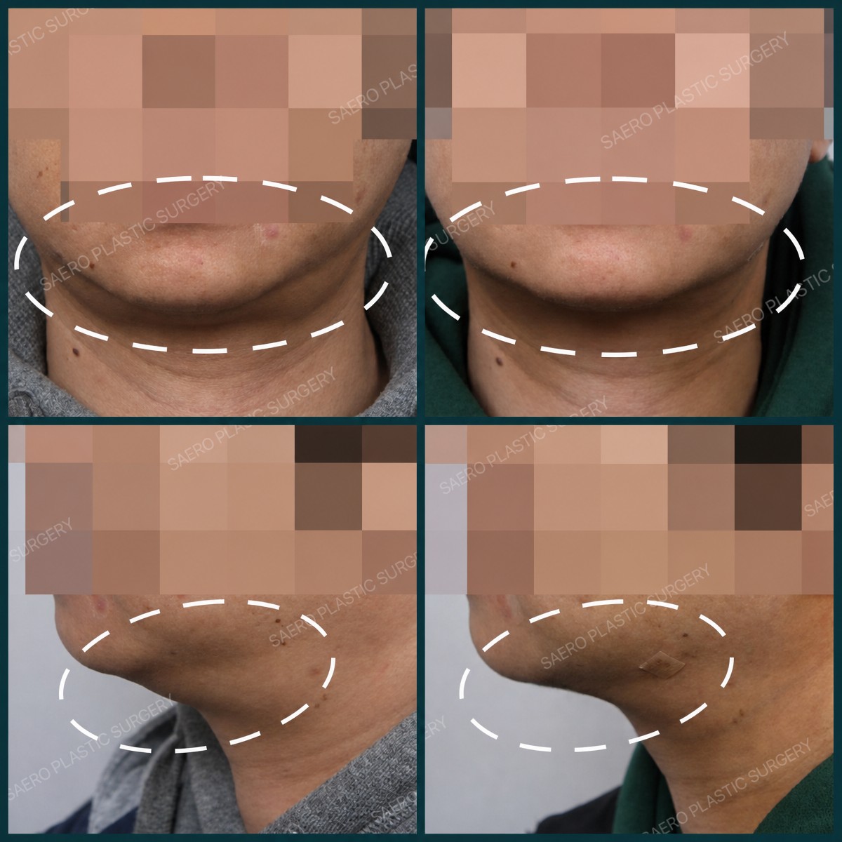 نتائج شفط الدهون قبل وبعد في SAERO Plastic Surgery، تحسين تحديد الفك
