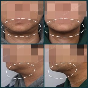 Résultats avant/après liposuccion chez SAERO Plastic Surgery, contour de mâchoire amélioré