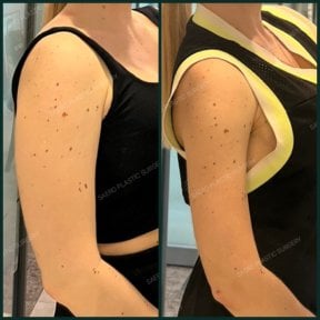 Before and after arm liposuction results at SAERO Plastic Surgery, improved arm contour