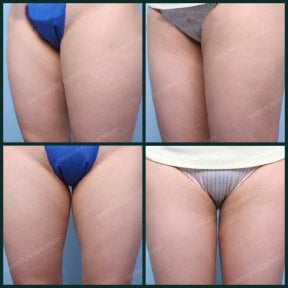 Résultats avant/après liposuccion chez SAERO Plastic Surgery, cuisses affinées