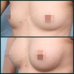 Before and after breast augmentation results at SAERO Plastic Surgery, enhanced breast volume
