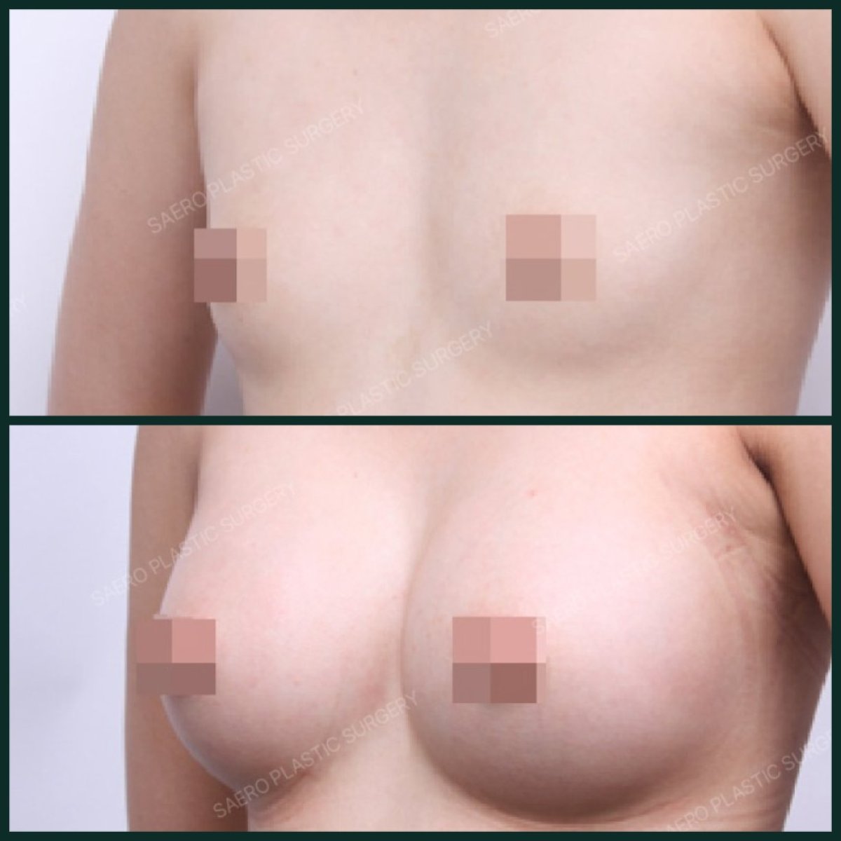 نتائج قبل وبعد تكبير الثدي في SAERO Plastic Surgery، زيادة حجم الثدي