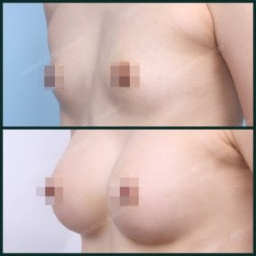 Before and after breast augmentation results at SAERO Plastic Surgery, enhanced breast volume