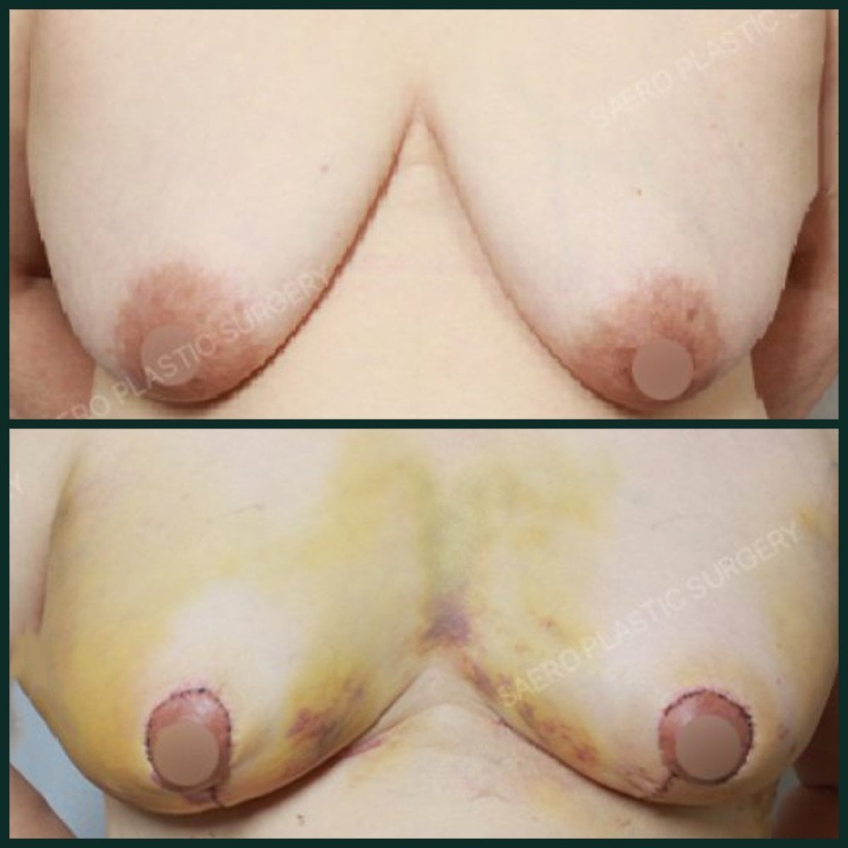 نتائج تصغير الثدي قبل وبعد في SAERO Plastic Surgery، تحسين شكل الثدي