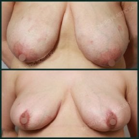Before and after breast reduction results at SAERO Plastic Surgery, improved breast contour