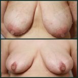 Before and after breast reduction results at SAERO Plastic Surgery, improved breast contour