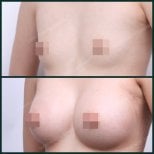Before and after breast augmentation with fat transfer at SAERO Plastic Surgery, visible results