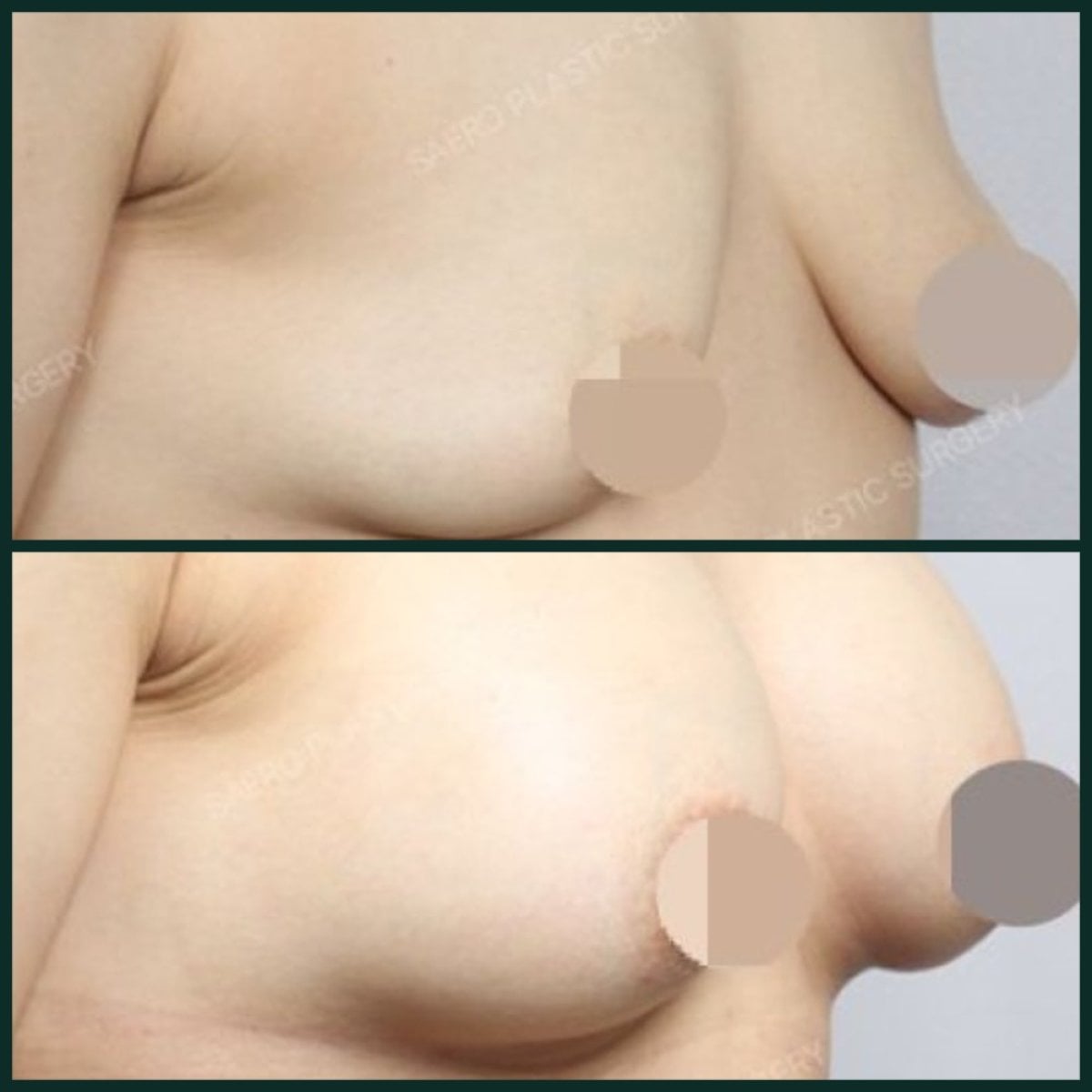Antes y después de aumento de senos con transferencia de grasa en SAERO Plastic Surgery, resultado visible