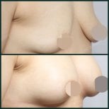 Before and after breast augmentation with fat transfer at SAERO Plastic Surgery, visible results