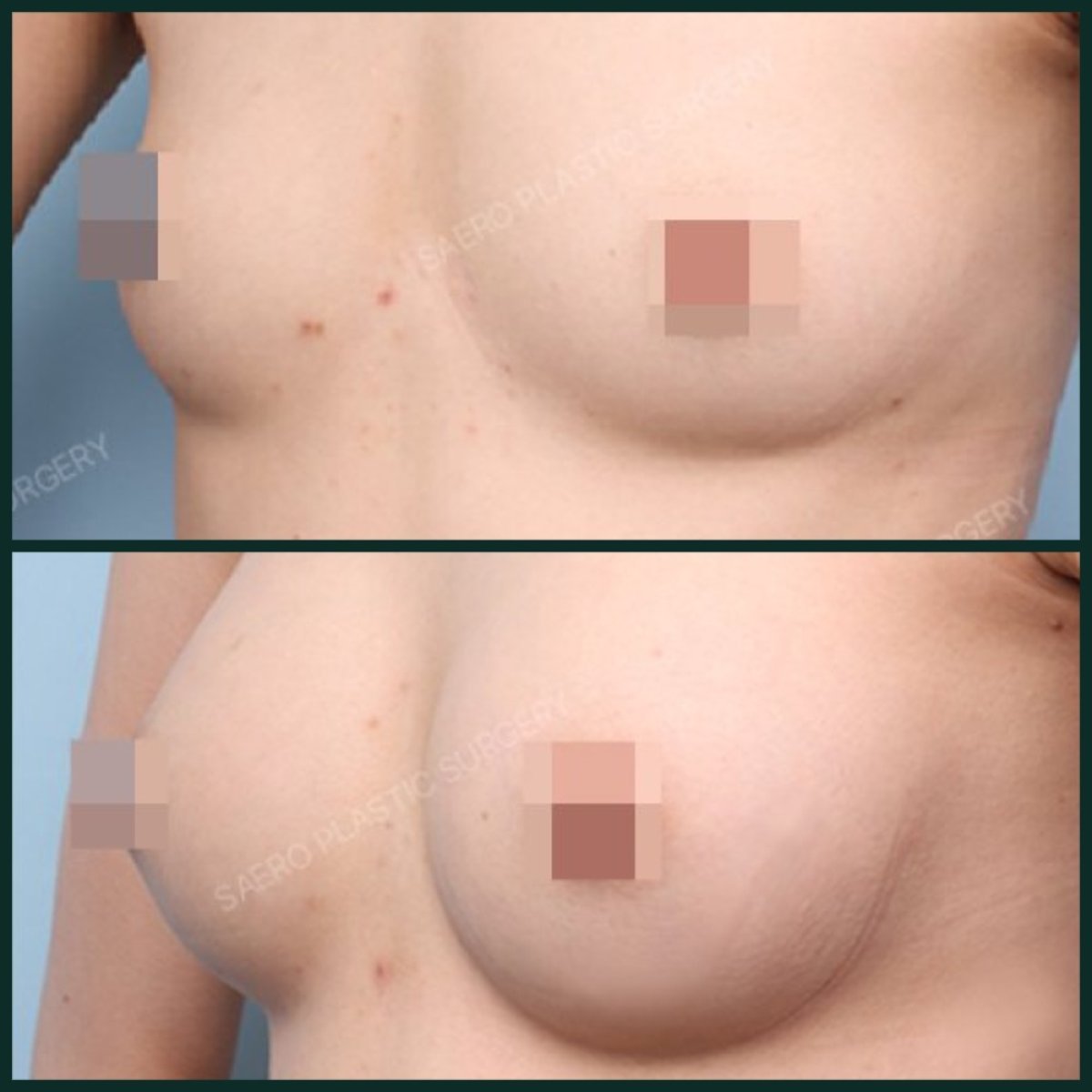 نتائج تكبير الثدي بحقن الدهون قبل وبعد في SAERO Plastic Surgery