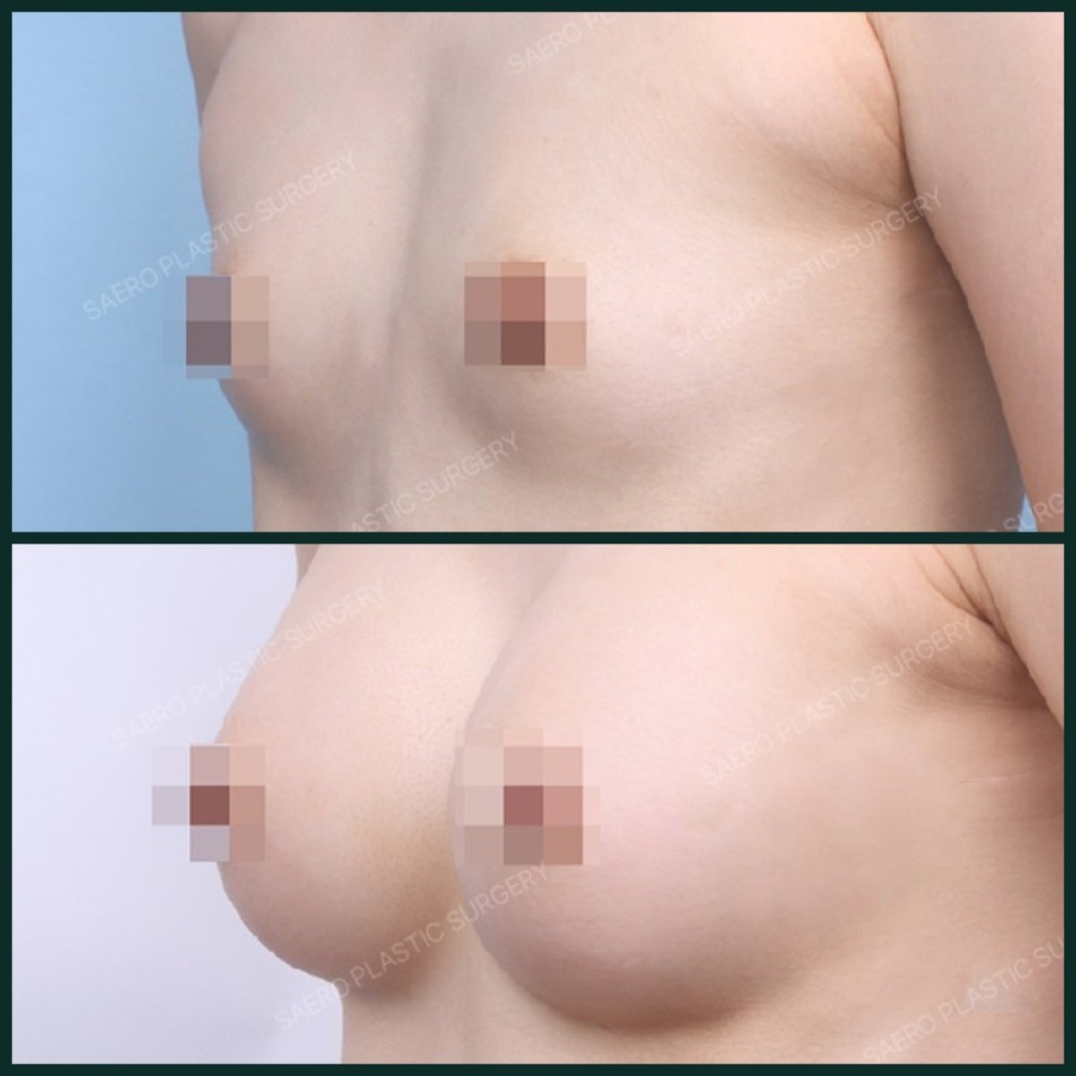 نتائج تكبير الثدي بحقن الدهون في SAERO Plastic Surgery قبل وبعد، نتائج واضحة