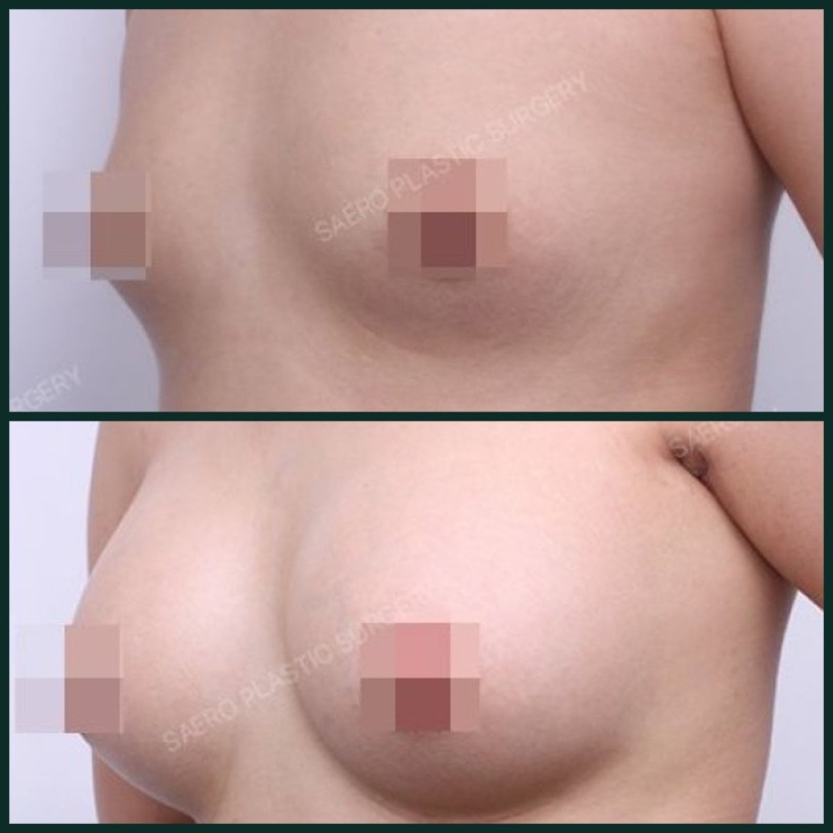 Antes y después de aumento de senos con transferencia de grasa en SAERO Plastic Surgery, resultados visibles