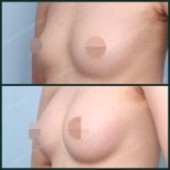 Before and after breast augmentation with fat transfer at SAERO Plastic Surgery, visible result