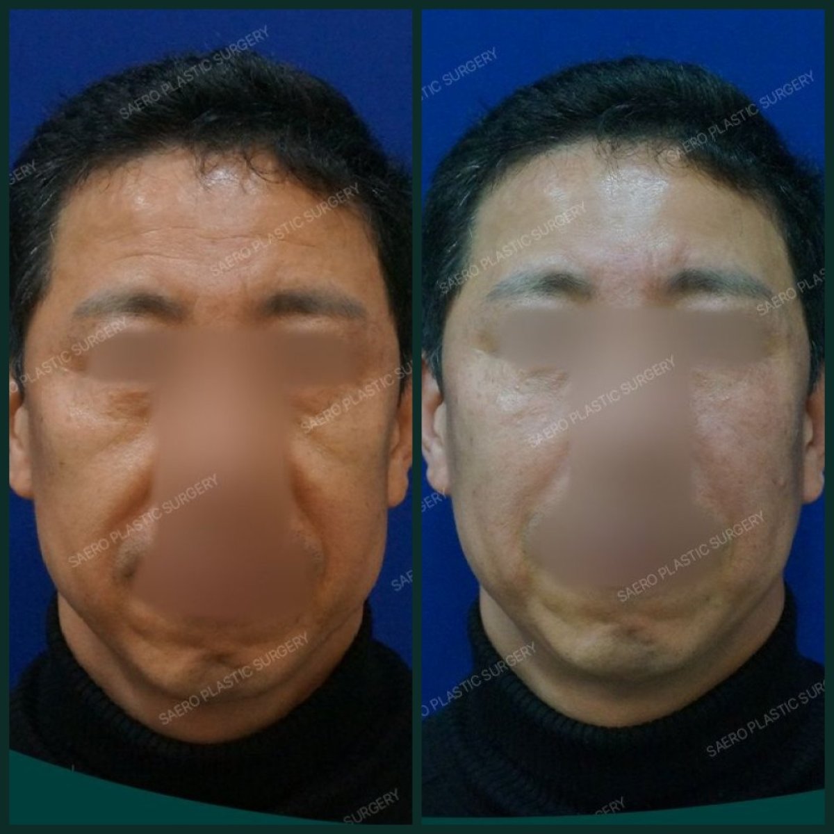 نتائج رفع الحاجب قبل وبعد في SAERO Plastic Surgery، تحسن ملحوظ في رفع الجبهة