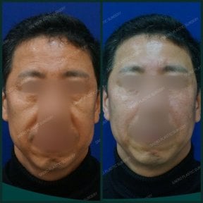 Результаты подтяжки бровей до и после в SAERO Plastic Surgery, видимый лифтинг лба
