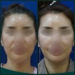 نتائج شد الحاجب قبل وبعد في SAERO Plastic Surgery مع تحسن ملحوظ في رفع الجبهة
