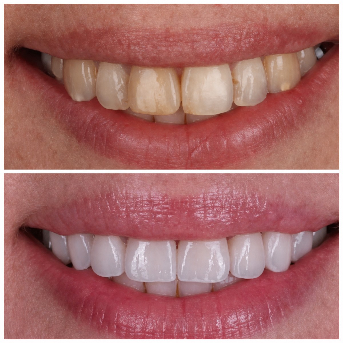 نتائج قبل وبعد الفينير في عيادة Dental Clinic Dynasty Stomatology في كراكوف، تجميل الابتسامة