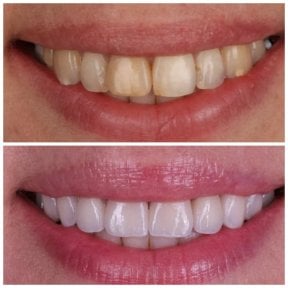 Результаты до и после установки виниров в Dental Clinic Dynasty Stomatology в Кракове