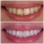 Результаты до и после установки виниров в Dental Clinic Dynasty Stomatology в Кракове