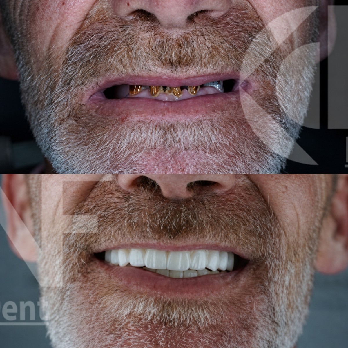 Resultados antes y después de implantes All-on-6 en Nifa Dent International, restauración de sonrisa