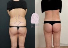 Résultats avant et après liposuccion chez Dr. MED – taille et dos affinés