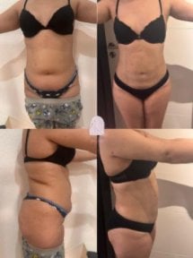 Résultats avant et après liposuccion chez Dr. MED – remodelage visible et réduction de graisse
